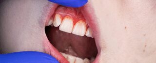 Gum Disease: Why Routine Check-Ups Are Essential