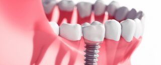 How does the dental implant procedure work?