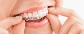 5 facts you NEED to know about Invisalign