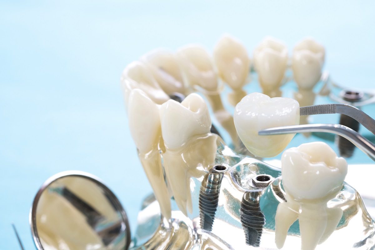 Advantages and Disadvantages of All-on-4 Dental Implants