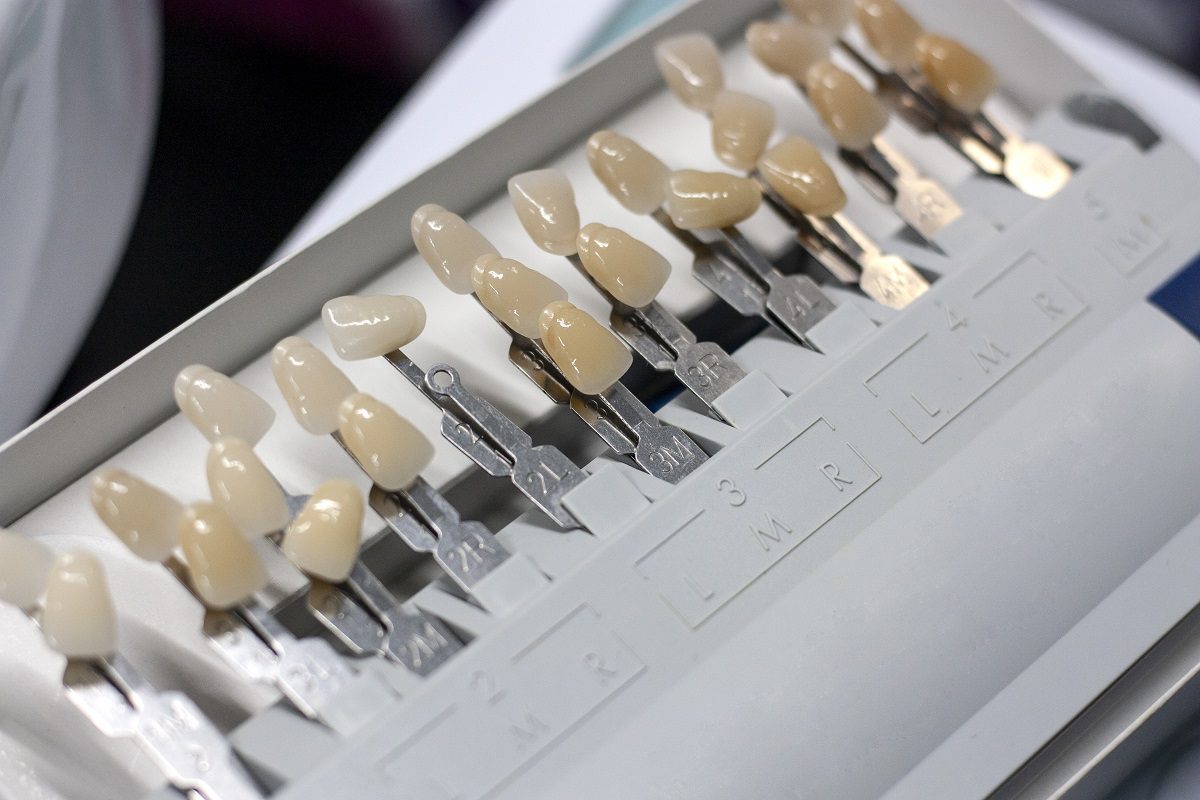 What to Expect from Dental Veneers Procedure?