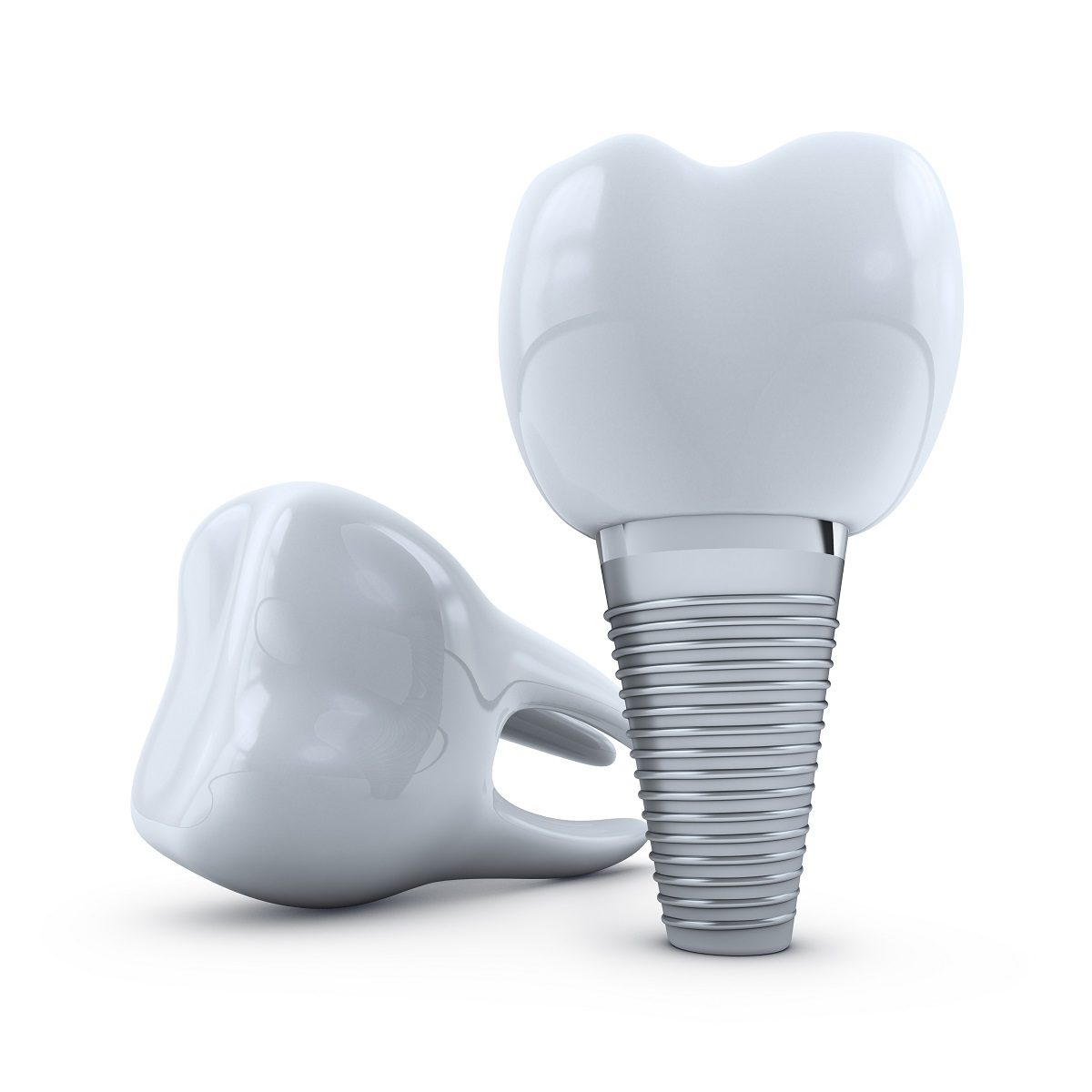 Most Common Types of Dental Implants