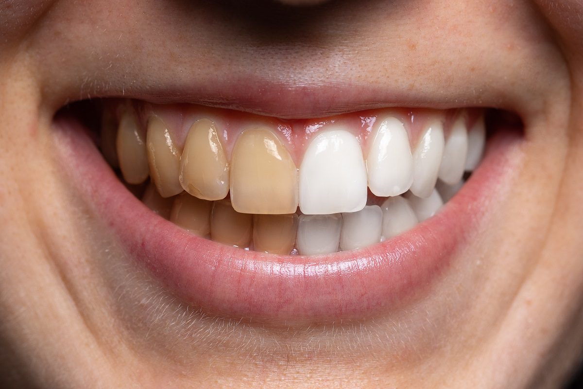 Everyday Habits That Cause Teeth Staining