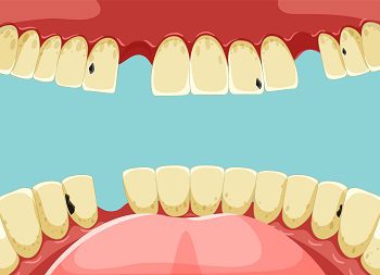 Everyday Habits That Cause Teeth Staining