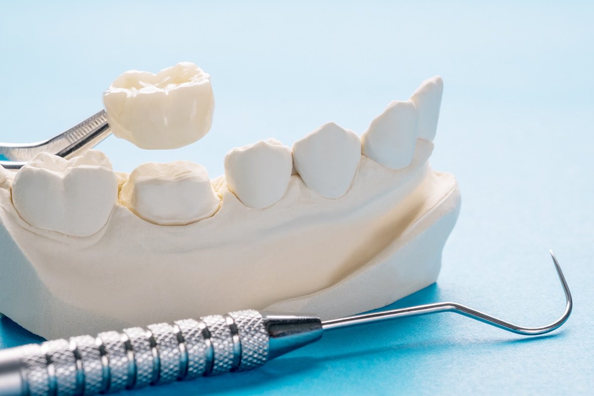 How are Same-Day and Traditional Dental Crowns different?