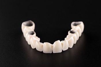 Why and when do you need Dental Veneers?