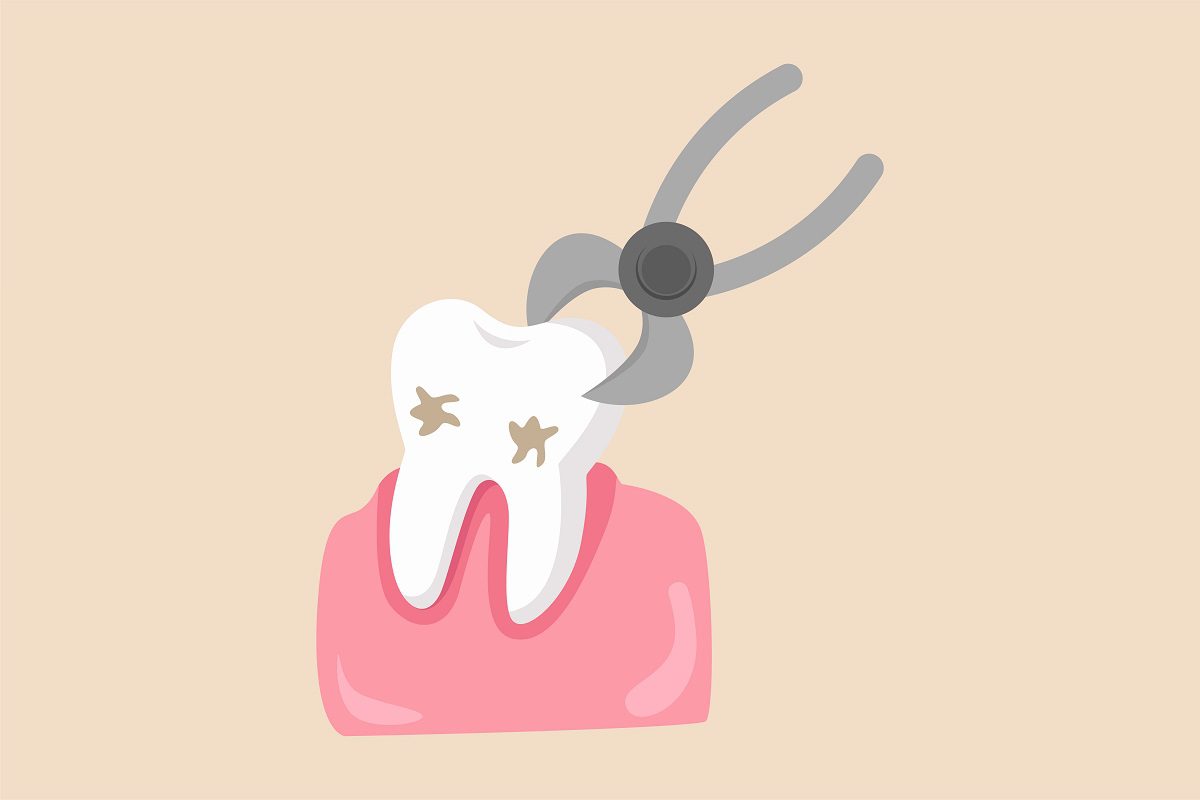 What is a Tooth Extraction Procedure, and Why may you need It?