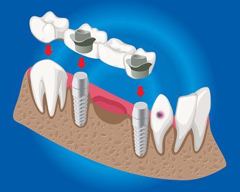 What Are Dental Crowns and Bridges?