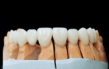 Pros And Cons of Dental Veneers
