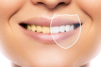 Introduction to Teeth Bleaching: What is it and How it Work? 