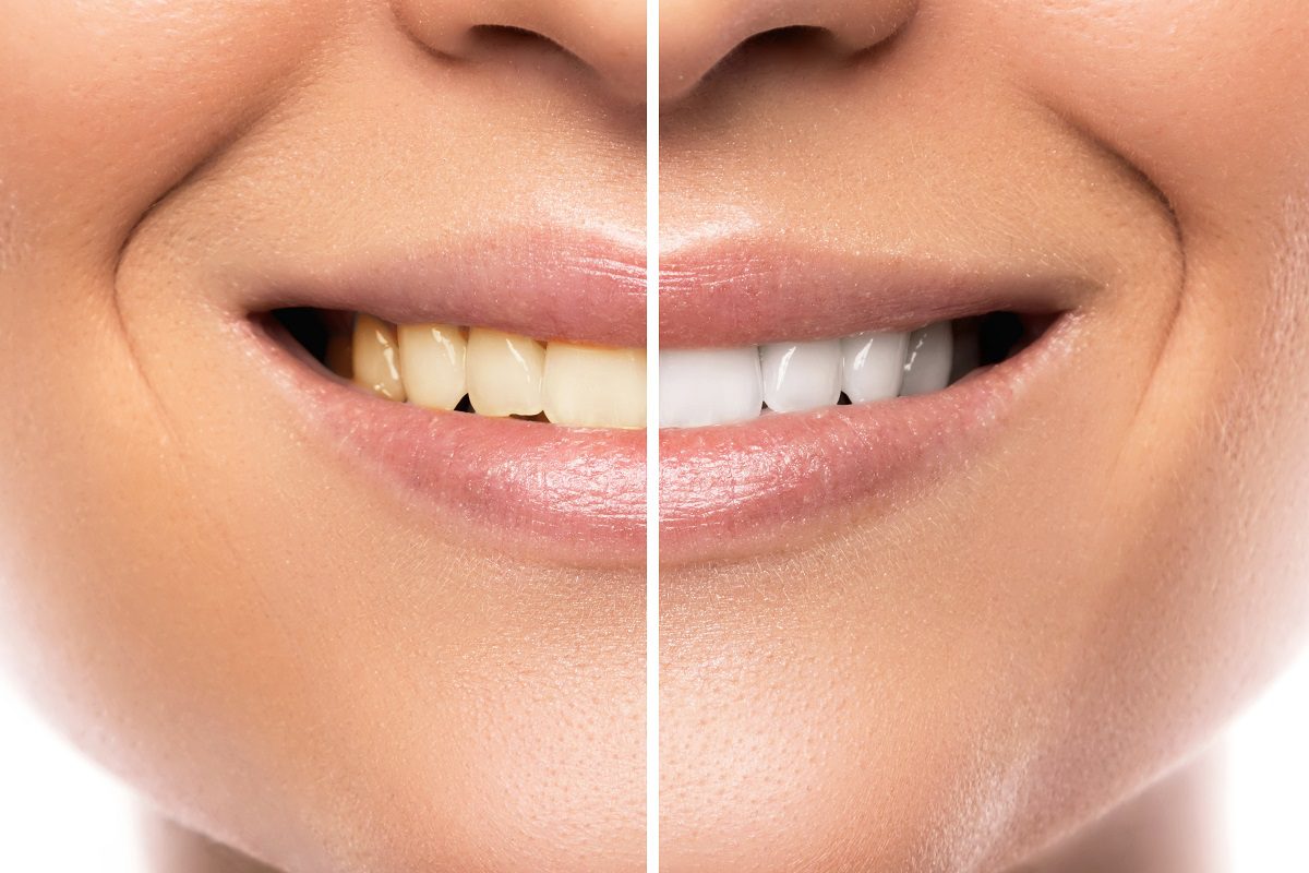 Types of Teeth Bleaching Methods: In-Office and Take-Home