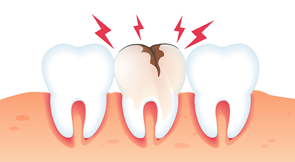 Tooth Trauma: First Aid for a Completely Displaced Tooth