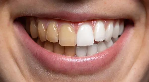 Teeth Bleaching Risks and Potential Side Effects 