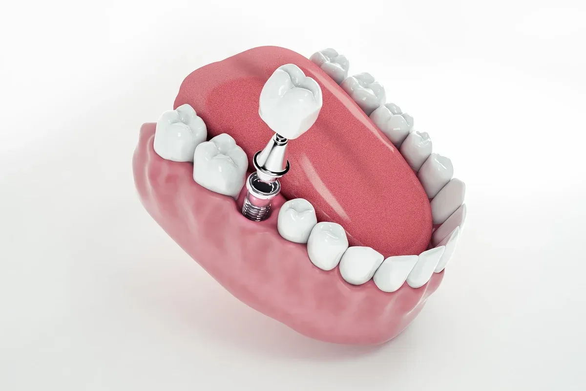 The Benefits of Dental Implants Over Other Tooth Replacement Options 